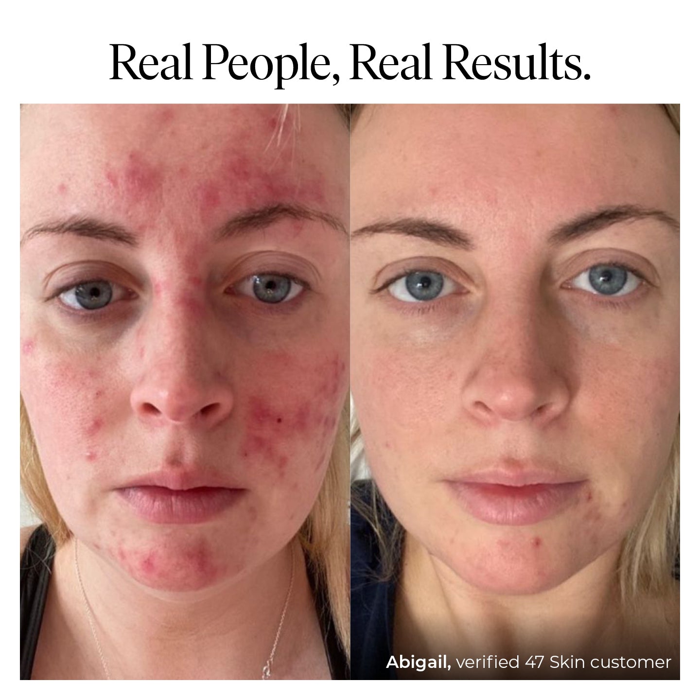 Anti-Blemish & Scar Repair 3 Step Set - Image 8